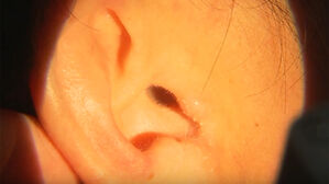 "갑자기 '삐-' 하는 소리…조금만 늦었어도 청력 잃을 뻔"