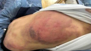 무속인 부부 아동학대로 피해아동에 등에 난 멍(사진= 연합뉴스)