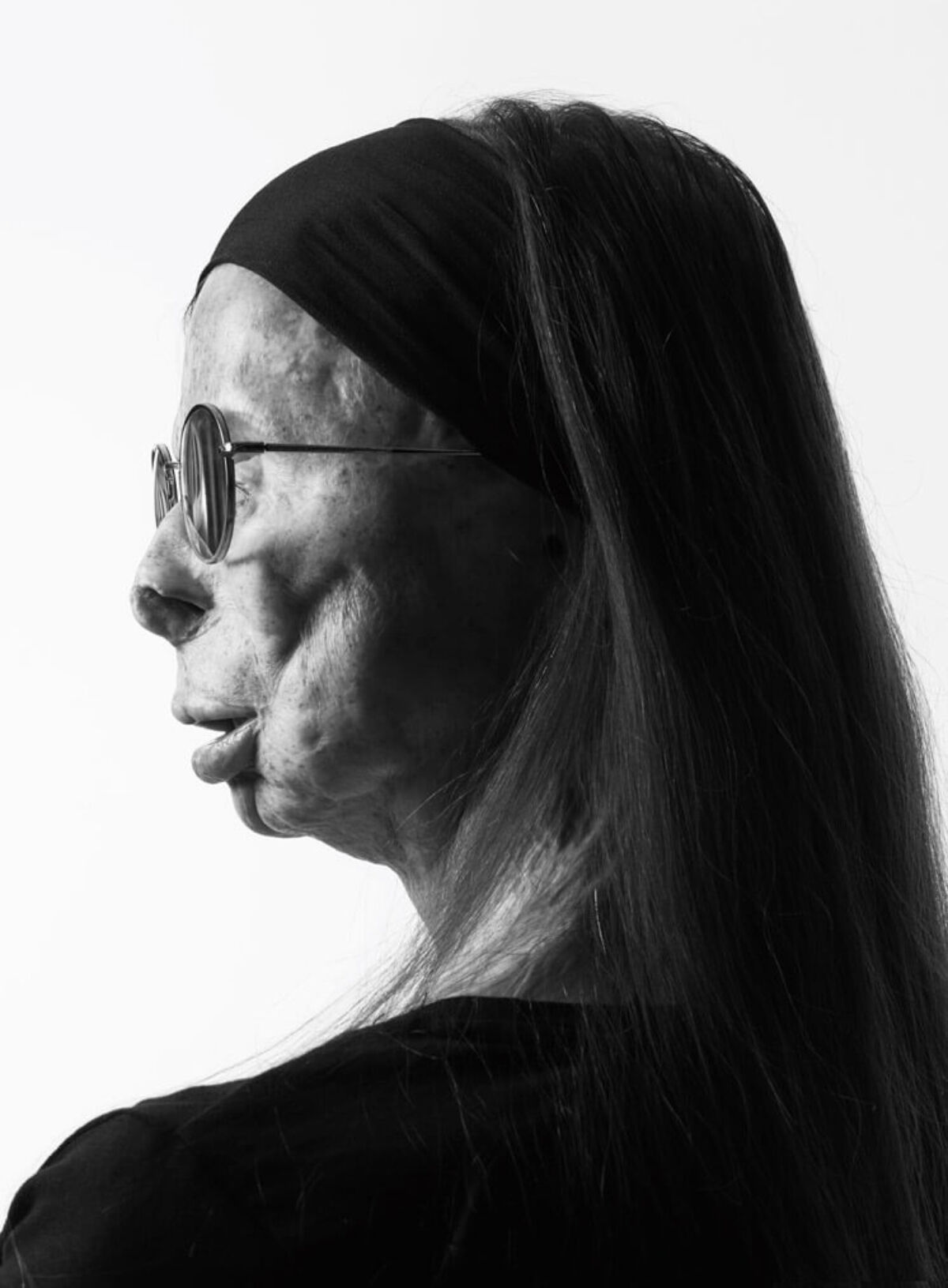 황산테러 생존자 패트리샤 르프랑 화보 (사진= A.S.T.i(Acid Survivors Trust International) 홈페이지)