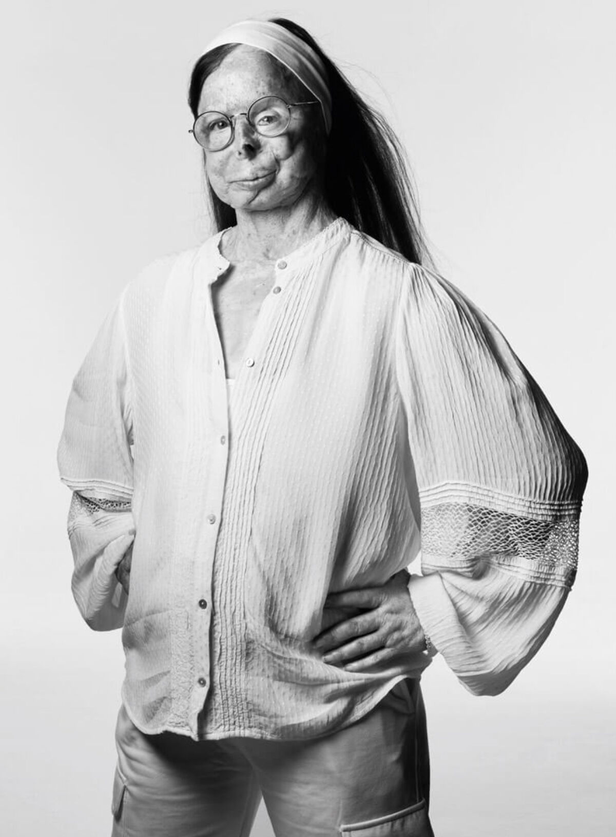 황산테러 생존자 패트리샤 르프랑 화보 (사진= A.S.T.i(Acid Survivors Trust International) 홈페이지)