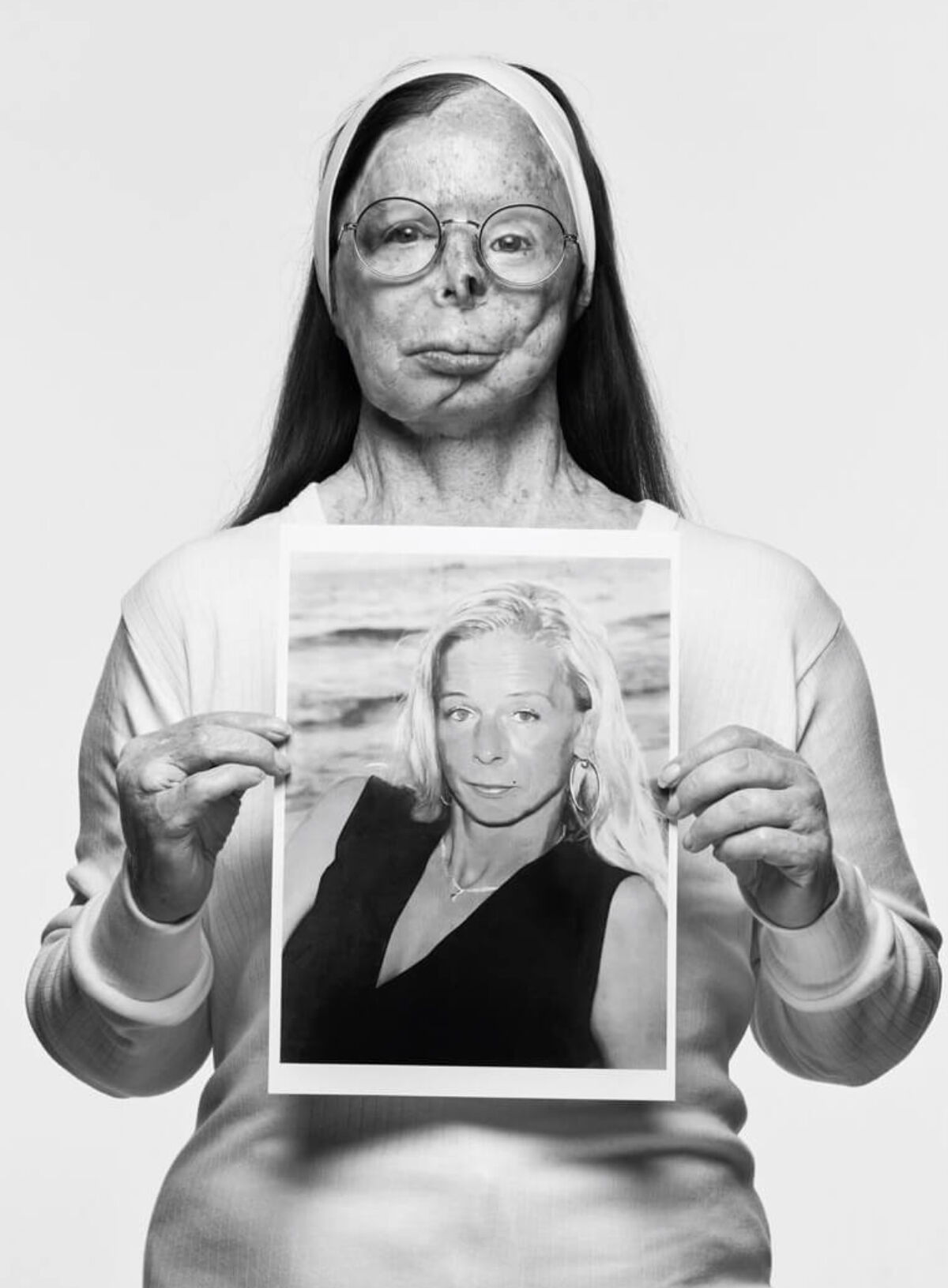 황산테러 생존자 패트리샤 르프랑 화보 (사진= A.S.T.i(Acid Survivors Trust International) 홈페이지)