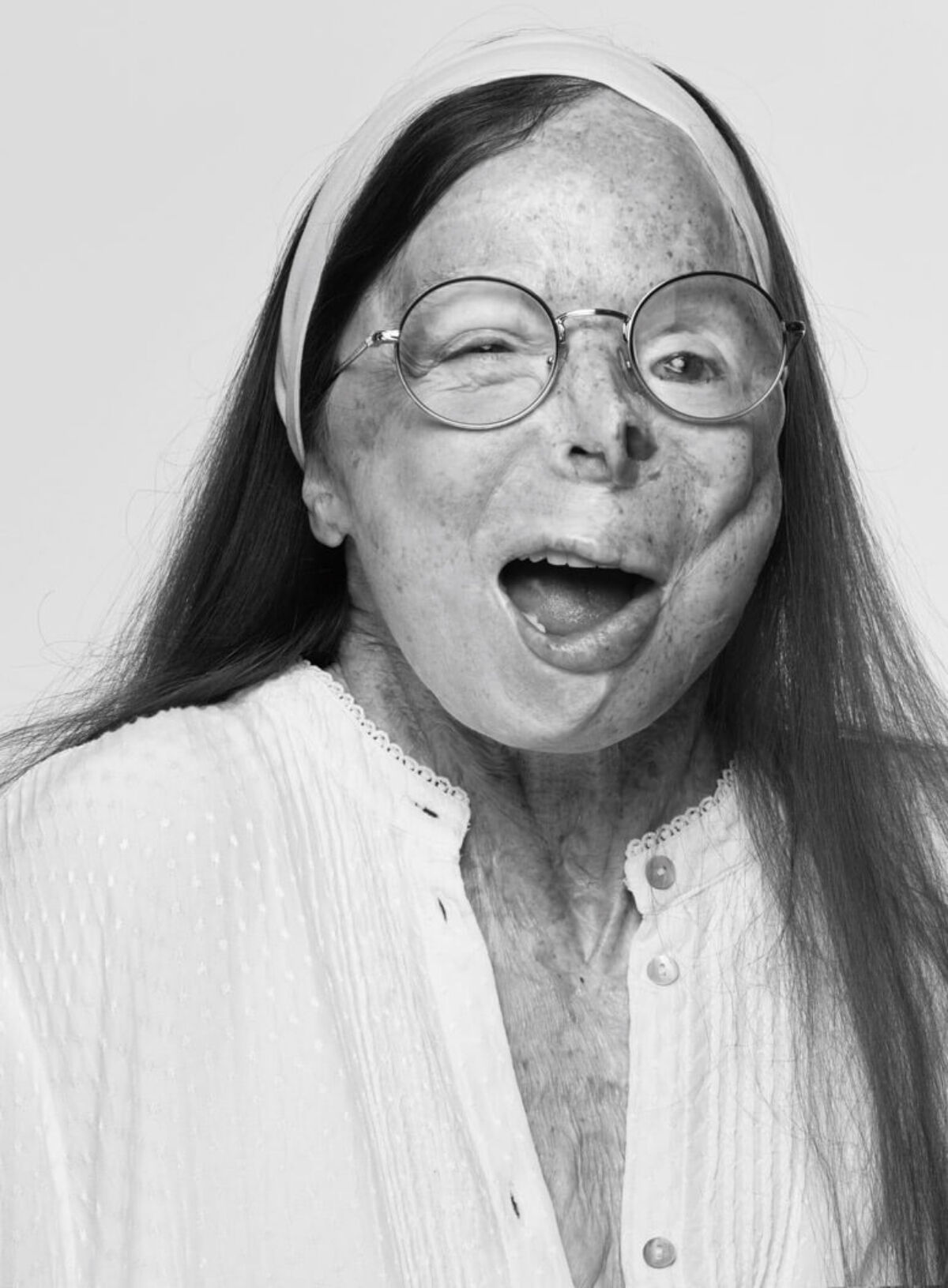 황산테러 생존자 패트리샤 르프랑 화보 (사진= A.S.T.i(Acid Survivors Trust International) 홈페이지)