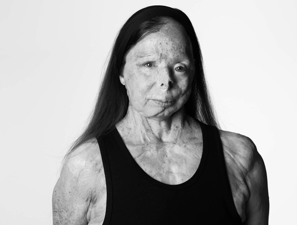 황산테러 생존자 패트리샤 르프랑 화보 (사진= A.S.T.i(Acid Survivors Trust International) 홈페이지)