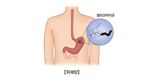 "위장 헬리코박터 감염, 대장암과 연관 있다"