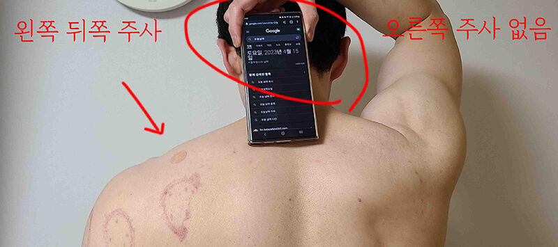 환자가 왼쪽 어깨에만 주사를 맞았으나 병원은 양쪽 어깨에 다 주사를 놓은 것으로 진료기록을 작성해 건보료를 신청했다고 한다. 
