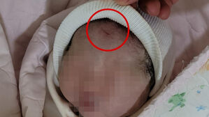 "45살에 어렵게 얻은 딸인데&hellip;" 흉터 남긴 병원 대응 '분통'