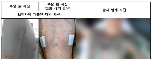 보험사에 제공된 가짜 사진(왼쪽)과 가짜 환자 사진