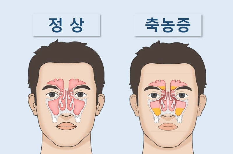 부비동에 고름이 찬 모습 (사진=하나이비인후과병원 제공, 연합뉴스)