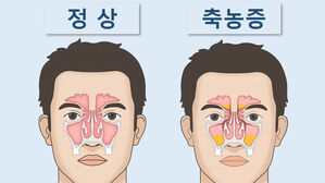"감기인 듯 아닌 듯 '부비동염'&hellip;방치 땐 큰코다칠 수도"