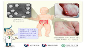백신 없는 수족구병, 최근 한 달간 2.3배↑&hellip;영유아가 90%