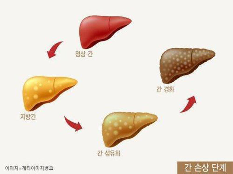 지방간 (사진=게티이미지뱅크 제공, 연합뉴스)