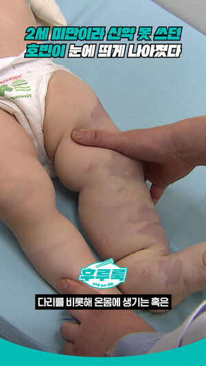 2세 미만이라 신약 못 쓰던 호빈이 눈에 띄게 나아졌다