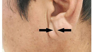 귓불에 주름 깊게 패었다면 주의?&hellip;"이 질환 증상 없기도"