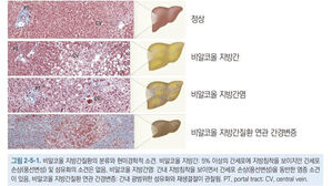 "술도 안 마시는데 지방간?&hellip;교대근무자에 발생 위험 높아"