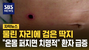 물린 자리에 검은 딱지&hellip;"온몸 퍼지면 치명적" 환자 급증