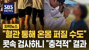 [자막뉴스] "혈관 통해서 온몸 퍼질 수도"&hellip;콧속 검사하니 "충격적" 결과