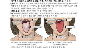 소아 성홍열 유행으로 환자 3천809명&hellip;전년 동기 2.5배