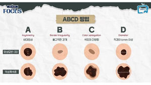 '점'인 줄 알았는데 '암'&hellip;알아두면 좋은 피부암 'ABCD룰'