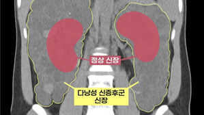 '신장 7배' 다낭성 신증후군 환자에 로봇 신장이식 아시아 첫 성공