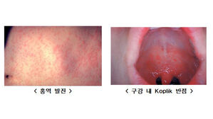 국내 홍역환자, 작년의 1.4배&hellip;"베트남 등 해외여행시 주의"