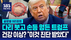 [글로벌D리포트] 트럼프 건강이상?&hellip;"정맥 부전, 70대에 흔해"