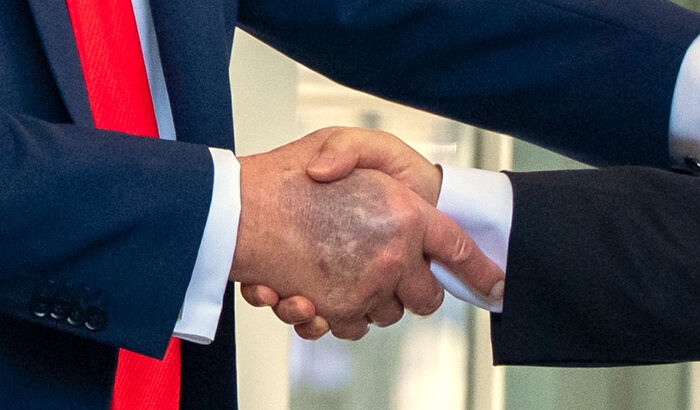 지난 8월 백악관에서 이재명 대통령과 악수하는 도널드 트럼프 미국 대통령(왼쪽)의 오른손 손등에 멍으로 보이는 검푸른 자국이 포착됐다. (사진=AP, 연합뉴스)