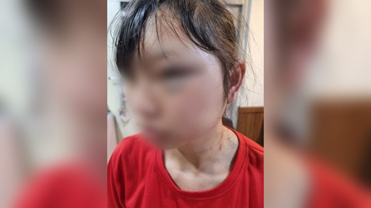 폭행 피해 당한 여성 이주노동자 B씨 (사진=B씨 측 제공, 연합뉴스)