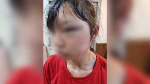 폭행 피해 당한 여성 이주노동자 B씨 (사진=B씨 측 제공, 연합뉴스)