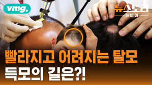 [뉴스토리 in 비머] 한 세대 걸러 유전? 탈모약 부작용! 튀르키예 모발이식! 탈모에 관한 모든 궁금증을 풀어드립니다