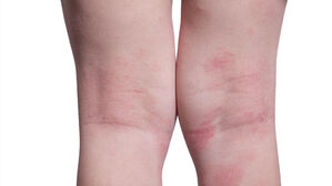 "아토피 아동, 라면·햄버거 등 먹으면 가려움 최대 2배로 증가"