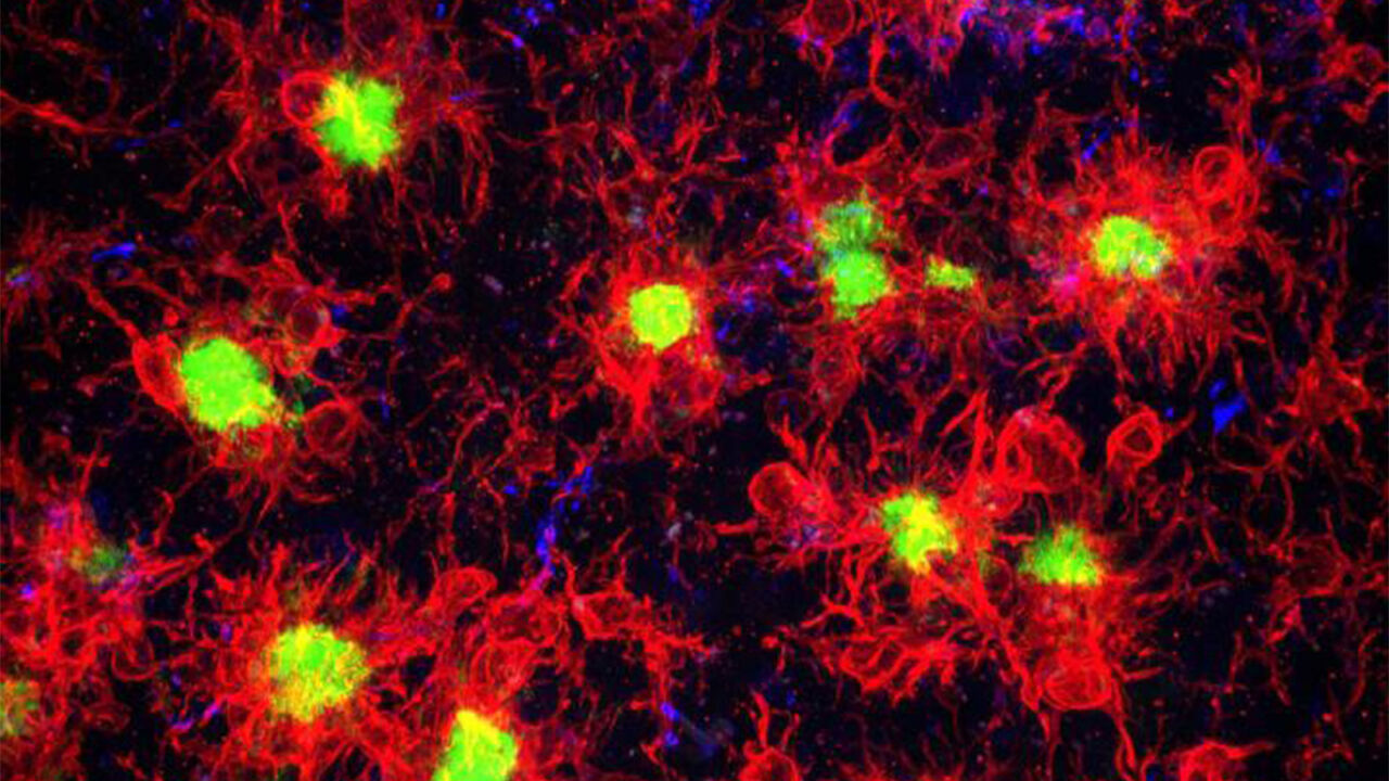 국립보건연구원 "한국인 치매 발병 관여하는 새 유전자 발견"
