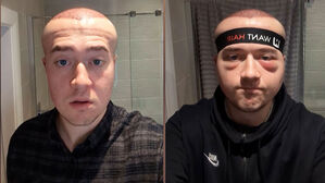 670만 원 들여 모발이식했는데…풍선처럼 머리 부푼 남성 