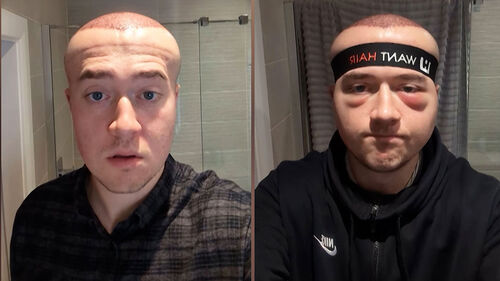 670만 원 들여 모발이식했는데…풍선처럼 부푼 머리