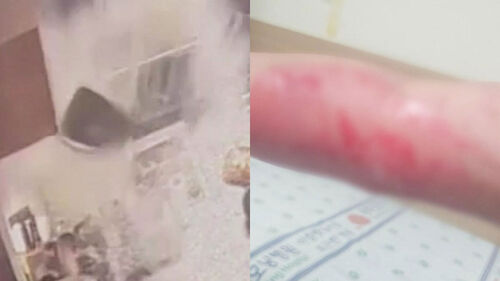 [사건X파일] 펄펄 끓는 튀김기 돌연 펑…2도 화상 입었는데