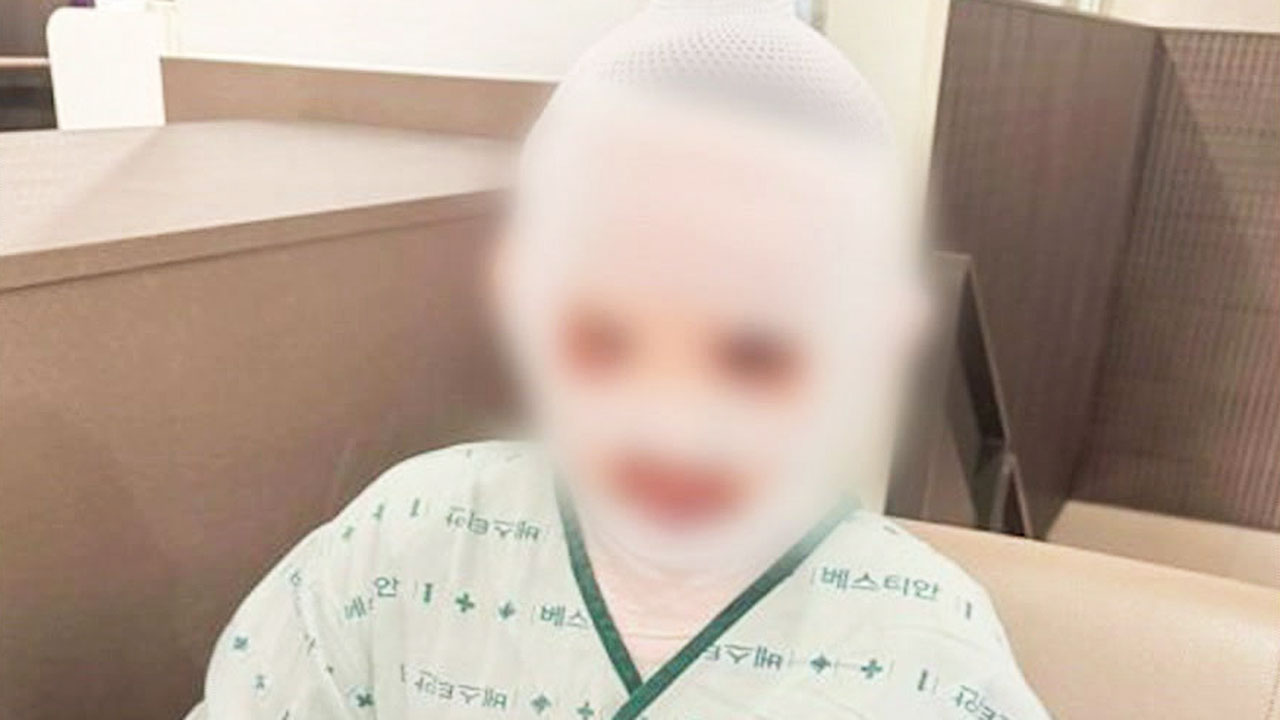 [빅토픽] 아내 잠든 사이…남편이 얼굴에 끓는 물 '확'