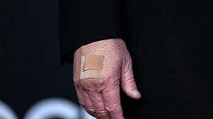 트럼프 손등 상태에 "왜 저래" 발칵…또 '건강이상설' 휩싸였다