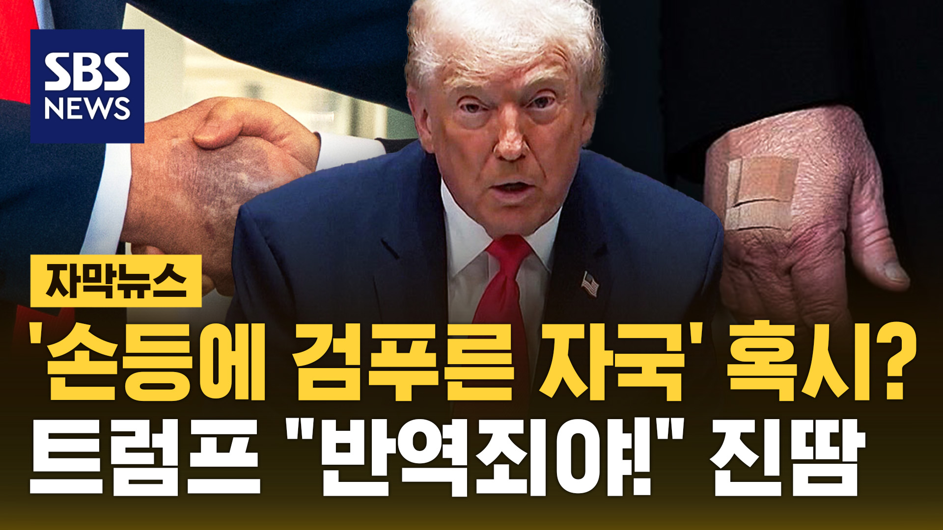 [자막뉴스] '손등에 검푸른 자국' 혹시? 트럼프 