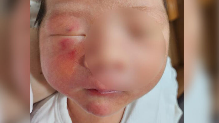 신생아실 찾은 부모 '철렁'…"얼굴 왜 이러나" 무슨 일