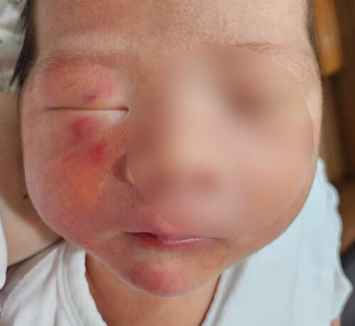 상처난 생후 4일 된 영아 얼굴 (사진=독자 제공, 연합뉴스)