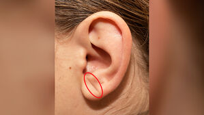 "단순 노화인 줄 알았는데" 귓불에 있는 주름 반전 실체