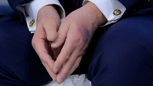 트럼프 손에 또 멍자국&hellip;이번엔 "테이블 부딪혔다"