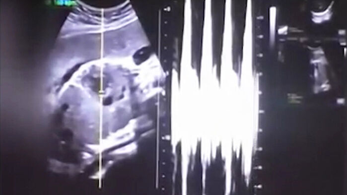 36-week abortion case