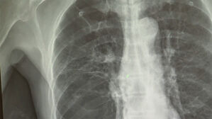 담배 안 피우는데 폐암?&hellip;"만성 폐질환 있으면 폐암 위험 3배"