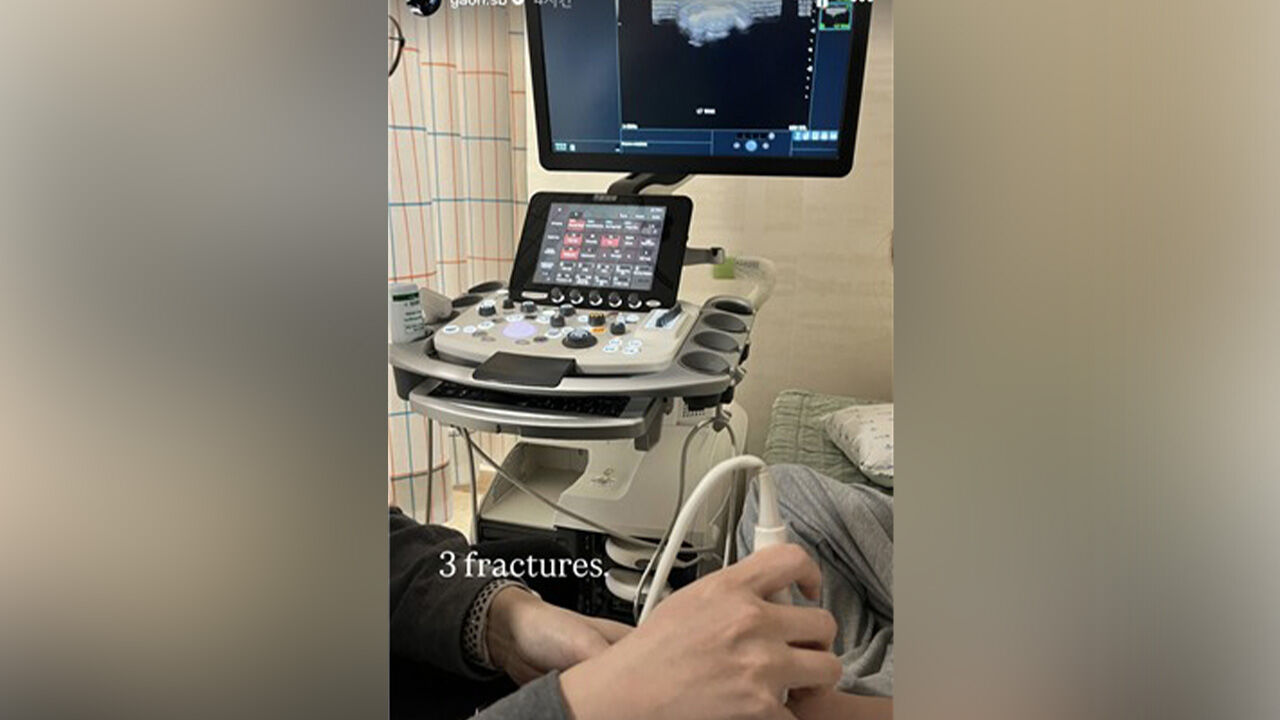 스노보더 최가온, 손바닥뼈 3개 골절