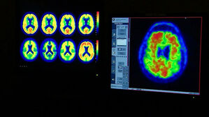 [이슈빡] 피검사로 치매 예측&hellip;'알츠하이머 시계'?