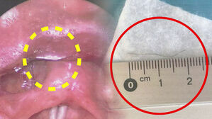 치킨 먹고 캑캑&hellip;"죽을 뻔" 식도에 박힌 2cm '경악'