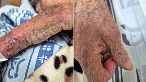 옴 악화에 '코끼리 피부' 된 90대 노인&hellip;요양센터 소극대응 논란