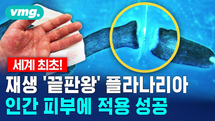 세계 최초! 재생 '끝판왕' 플라나리아, 인간 피부에 첫 적용