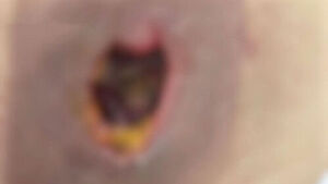 [사건X파일] 마사지숍에서 무슨 일이?&hellip;피부 괴사 "이식 필요"