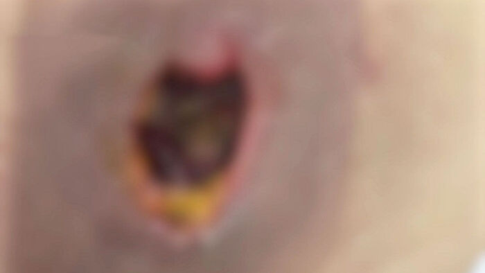 경기도의 프랜차이즈 마사지숍 갔다가 피부 괴사